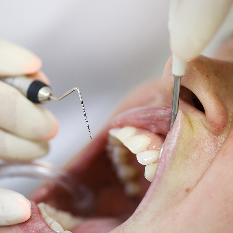 Prevenção doenças periodontais